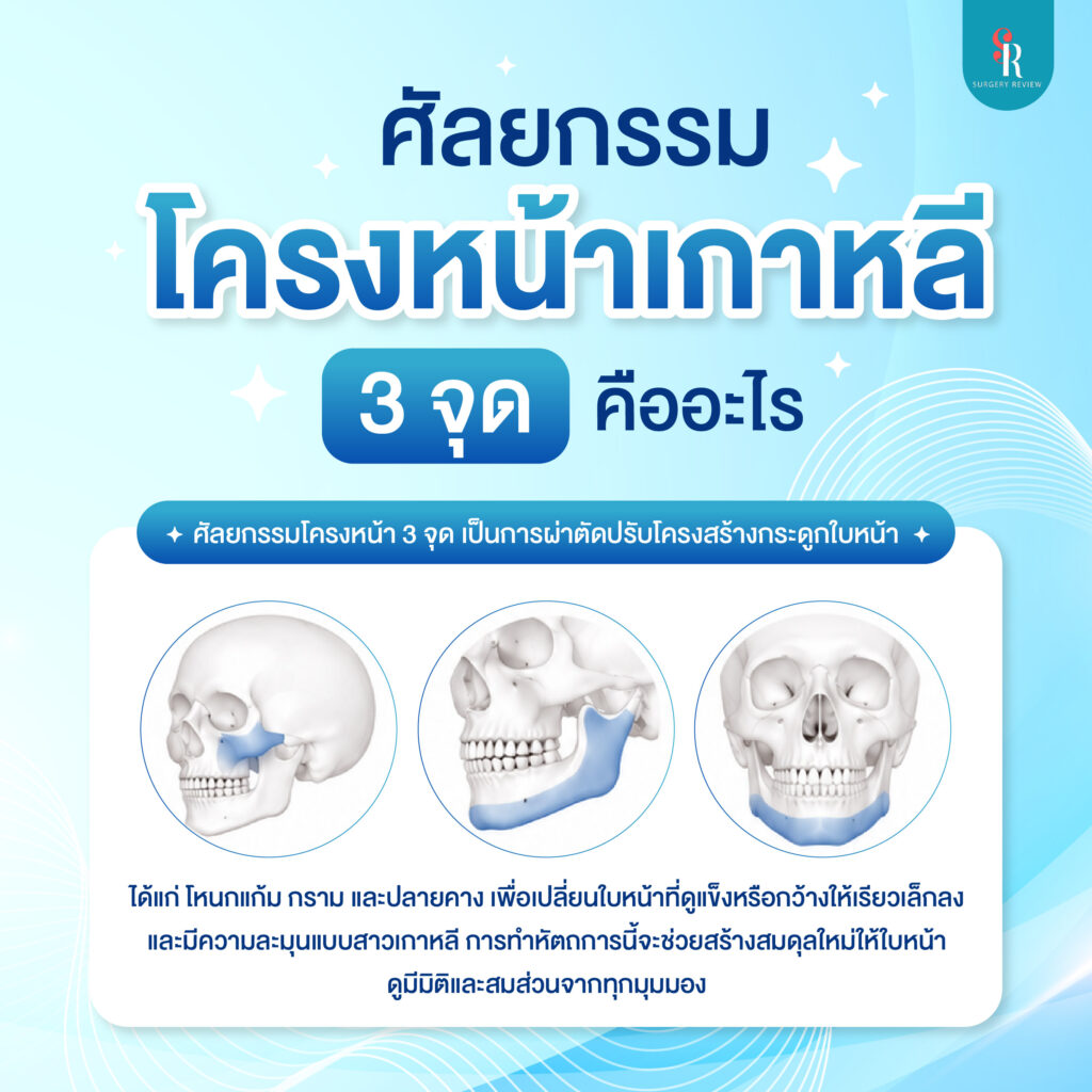 ศัลยกรรมโครงหน้า 3 จุด คืออะไร มีอะไรบ้าง